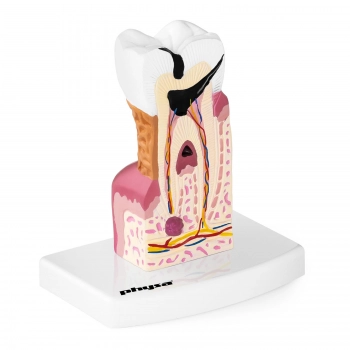 Model anatomiczny chorego zęba człowieka w skali 6:1