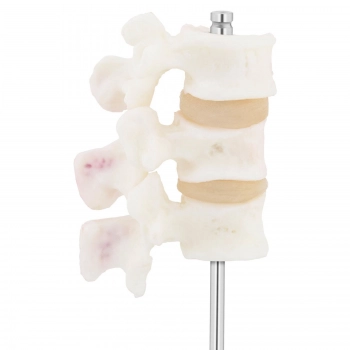 Model anatomiczny 3D osteoporozy lędźwiowej kręgi 3-5