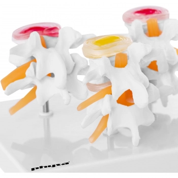 Model anatomiczny 3D zwyrodnienia odcinka lędźwiowego kręgosłupa - 4 etapy