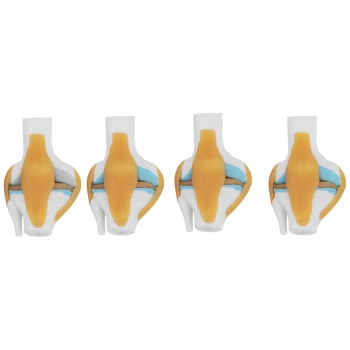 Model anatomiczny 3D stawu kolanowego ze zmianami chorobowymi 4 zmiany skala 1:2