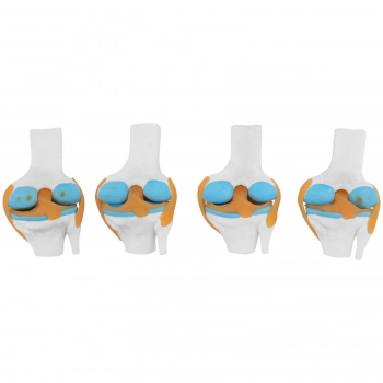 Model anatomiczny 3D stawu kolanowego ze zmianami chorobowymi 4 zmiany skala 1:2