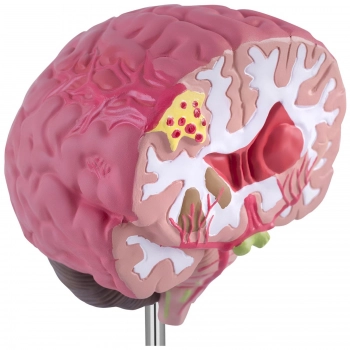 Model anatomiczny 3D mózgu ludzkiego z 3 patologiami skala 1:1